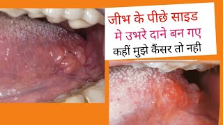 जीभ के पीछे दाने कैसे ठीक करें Bump on side of tongue swollen bumps on side of tongueHow to cure [upl. by Aleil603]