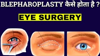 How Blepharoplasty Is Performed  Blepharoplasty  Eyelid Surgery Animation [upl. by Enelegna875]