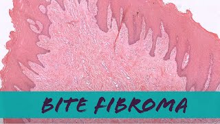 Bite fibroma in mouth aka irritation fibromaoral fibroma pathology dermpath dermatology [upl. by Tay50]