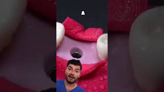 Dental Implant Explained [upl. by Alec]