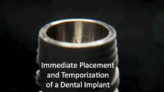 EXPLICIT  Immediate placement  Dental Implant [upl. by Doloritas]