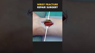 Wrist Fracture Repair Surgery  Distal Radius Fracture ytshorts fracture [upl. by Fatma]