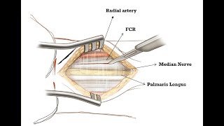 Volar Henry Approach to the Wrist [upl. by Egiarc]