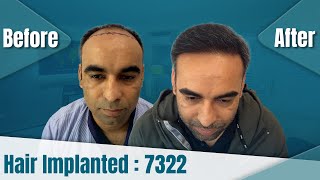 Best Hair Transplant In DelhiNCR 😎  Hair Transplant Cost In Delhi  DHI™ India [upl. by Yrannav178]