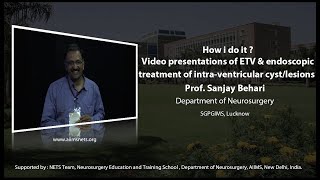 How i do it  Video presentations of ETV and endoscopic treatment of intraventricular cystlesions [upl. by Urbano]