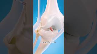 How Surgeons Fix Torn Ligaments in Your Knee short [upl. by Carly4]