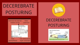 DECEREBRATE POSTUREAbnormal Posturing [upl. by Yarvis]