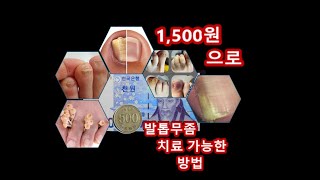 1008 단돈 1500원으로 발톱무좀 치료 가능한 방법 [upl. by Gunar]