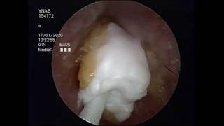 Fungal Infection and Ear Wax  The Art of Removal and Treatment Subtitled [upl. by Roos]