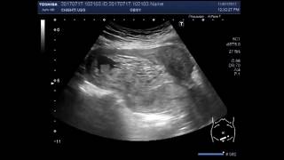 Ultrasound Video showing an incomplete abortion with retained products of conception [upl. by Dinny373]