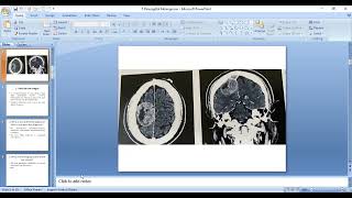 5 Parasagittal meningioma [upl. by Asirem]