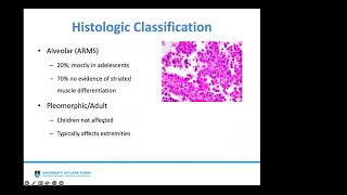 Surgical considerations for Rhabdomyosarcoma in children Dr Charles Moyo [upl. by Nilved913]