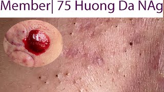 Acne Treatment Huong Da Nang 075  Member Happy International Womens Day [upl. by Orvie]