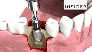 How Dentists Insert Dental Implants [upl. by Culliton93]