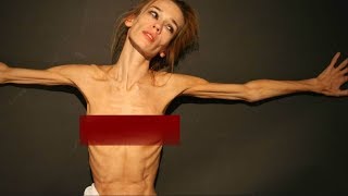 Thin  An Anorexia True Story  Anorexia Documentary TV [upl. by Yzmar830]