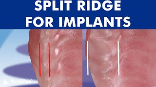 ALVEOLAR RIDGE EXPANSION  Dental implant placement with bone ridge splitting © [upl. by Lisette598]