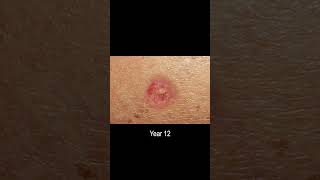 Basal Cell Carcinoma Skin Cancer Development Time Lapse Normal to Cancer Over 25 Years [upl. by Aelram]