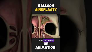 Balloon Sinuplasty 🤔explained [upl. by Berkin456]