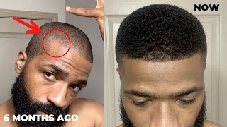 How to derma roll for thinning hairline and corners [upl. by Atsyrc]