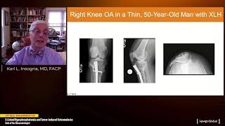 Optimal Management of XLinked Hypophosphatemia and TumorInduced Osteomalacia [upl. by Hayden]