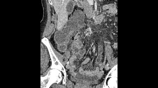 Appendicitis  perforated  complicated  appendicoliths present [upl. by Rahman]