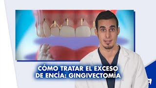 Qué es la SONRISA GINGIVAL y cómo se corrige  Shorts [upl. by Nalek142]