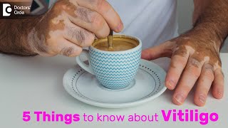 Vitiligo Types Symptoms Causes Treatment amp Recovery  Dr Divya Sharma  Doctors Circle [upl. by Meredithe]