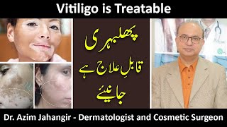 Vitiligo Phulbehri is Treatable In Pakistan Treatment Procedures With ProfDrAzim Jahangir Khan [upl. by Alisha773]