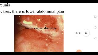 Trichomoniasis [upl. by Sofie]
