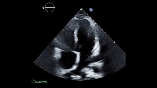 Transthoracic Echocardiogram Showing Signs of Constrictive Physiology [upl. by Averell25]