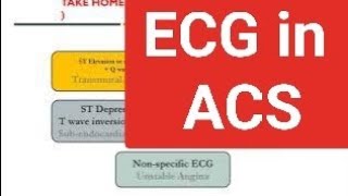 ECG in Acute coronary syndrome  case based approach with examples [upl. by Farrah]