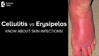 CELLULITIS vs ERYSIPELAS Know more about these SKIN INFECTIONSDr Rajdeep Mysore  Doctors Circle [upl. by Celene]