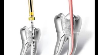 Endodontie  les étapes du traitement endodontique en détail [upl. by Ishmul]