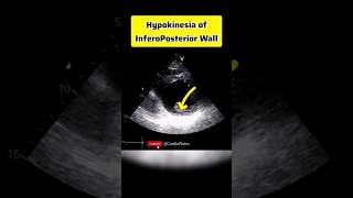 Hypokinetic InferoPosterior Wall anatomy heartphysiology heart echocardiagram [upl. by Akiret]