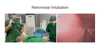 Retromolar Intubation [upl. by Gwennie]