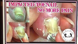 Impacted Toenail Relief and Prevention LIVE 🔴✔️ [upl. by Obola608]