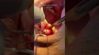 Surgical excision of Pyogenic Granuloma [upl. by Zurn]