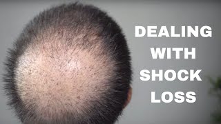 Shock Loss After a Hair Transplant and how to deal with it [upl. by Cranford275]