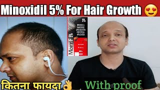 Minoxidil 5 Result for Hair growthMinoxidil with finasteride Effective result on Hairloss 😍 [upl. by Stormi]