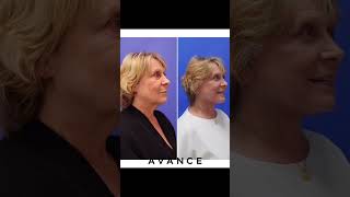 Reno Mini NeckliftFacelift Before and After  Avance Plastic Surgery Institute Dr Erez Dayan [upl. by Nawyt]