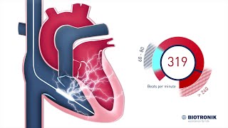 Implantable Cardioverter Defibrillator  How it works [upl. by Reidar142]