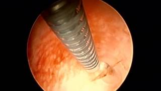 Vidéo  pose dun implant tubaire ESSURE unilatéral gauche sous hystéroscopie [upl. by Ima917]