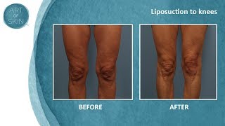 Lipo of knees [upl. by Asnarepse]