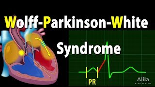 WolffParkinsonWhite Syndrome Pathophysiology PreExcitation and AVRT Animation [upl. by Jard]