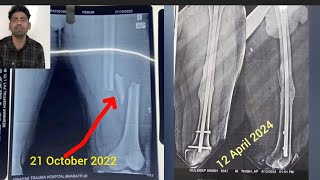 FULL RECOVERY AFTER 18 MONTHS  Multiple femur fracture Tibia fibula amp Ankle joint Fracture [upl. by Elacim529]