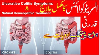 Ulcerative Colitis Treatment  Homeopathic Treatment of Ulcerative Colitis [upl. by Siocnarf979]