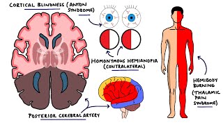 Posterior Cerebral Artery Stroke Syndromes  PCA Stroke Syndromes  Stroke Syndromes [upl. by Enait]