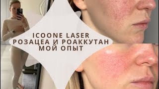 Icoone Laserмой опытСистемные ретиноиды при розацеа роаккутан [upl. by Angela]