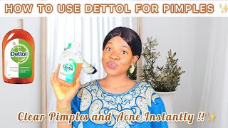 HOW TO USE DETTOL ANTISEPTIC LIQUID TO CLEAR YOUR PIMPLES ACNE amp BREAKOUTS Get rid of Acne wDettol [upl. by Chelsae]