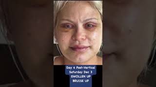 DayByDay Facelift Recovery amp Transformation [upl. by Alik]